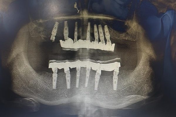 IMPLANT2